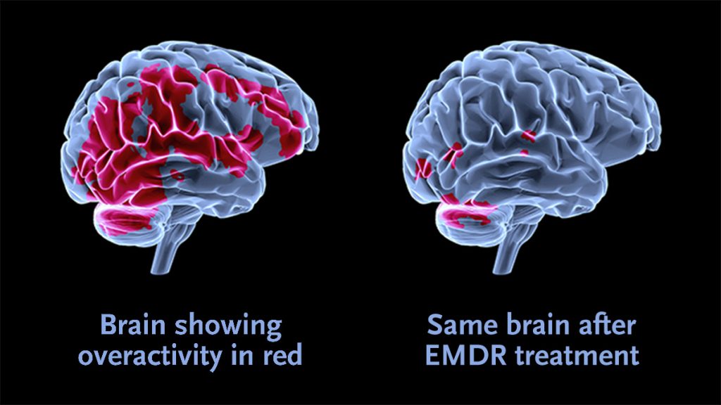 Terapie EMDR